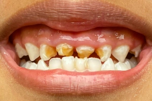 Close-up of discolored teeth