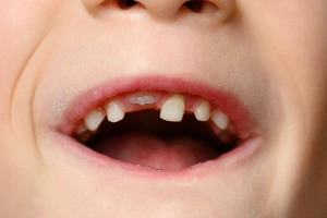 Tooth with large cavity