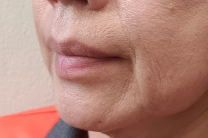 Tooth with large cavity