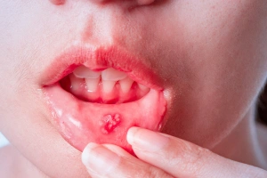 Cracked tooth diagram