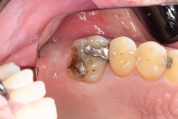 Cracked tooth diagram