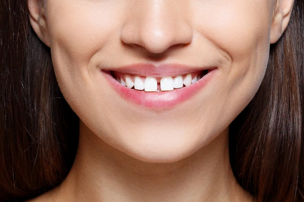 Cracked tooth diagram