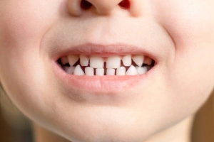 Cracked tooth diagram