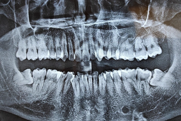 Cracked tooth diagram
