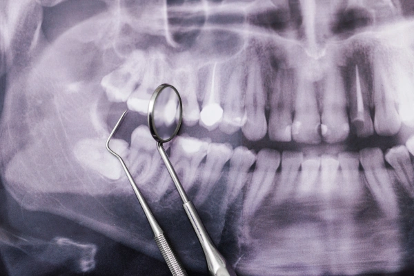 Pus or boil near tooth