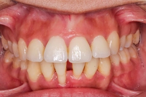 Pus or boil near tooth