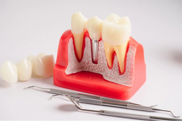 Cracked tooth diagram