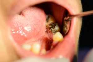 Tooth with large cavity