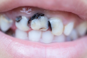 Cracked tooth diagram