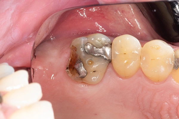 Cracked tooth diagram
