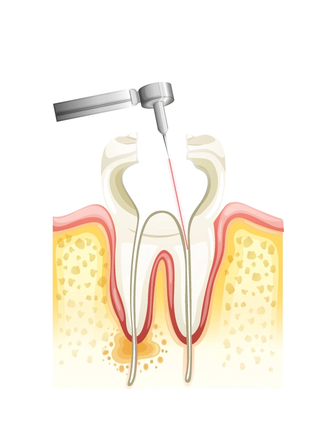 Removing soft tissue