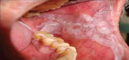 Removing soft tissue