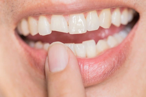 Cracked tooth diagram