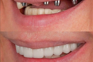 Tooth with large cavity