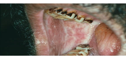 Removing soft tissue