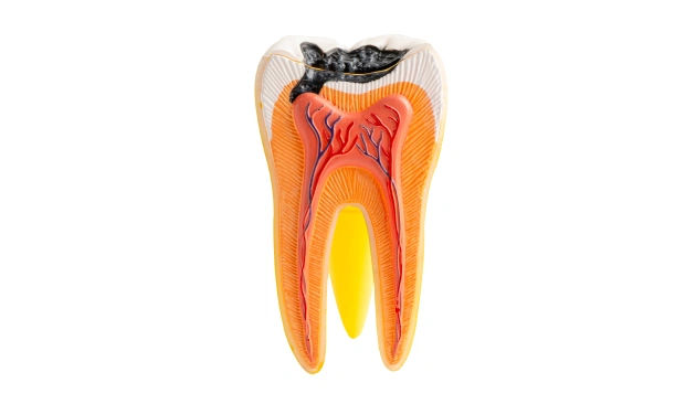 Cracked tooth diagram