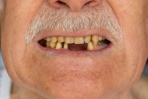 Cracked tooth diagram