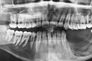 Tooth with large cavity