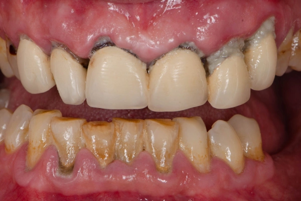 Cracked tooth diagram