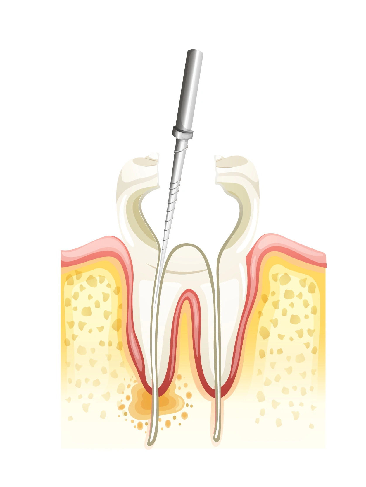 Removing soft tissue