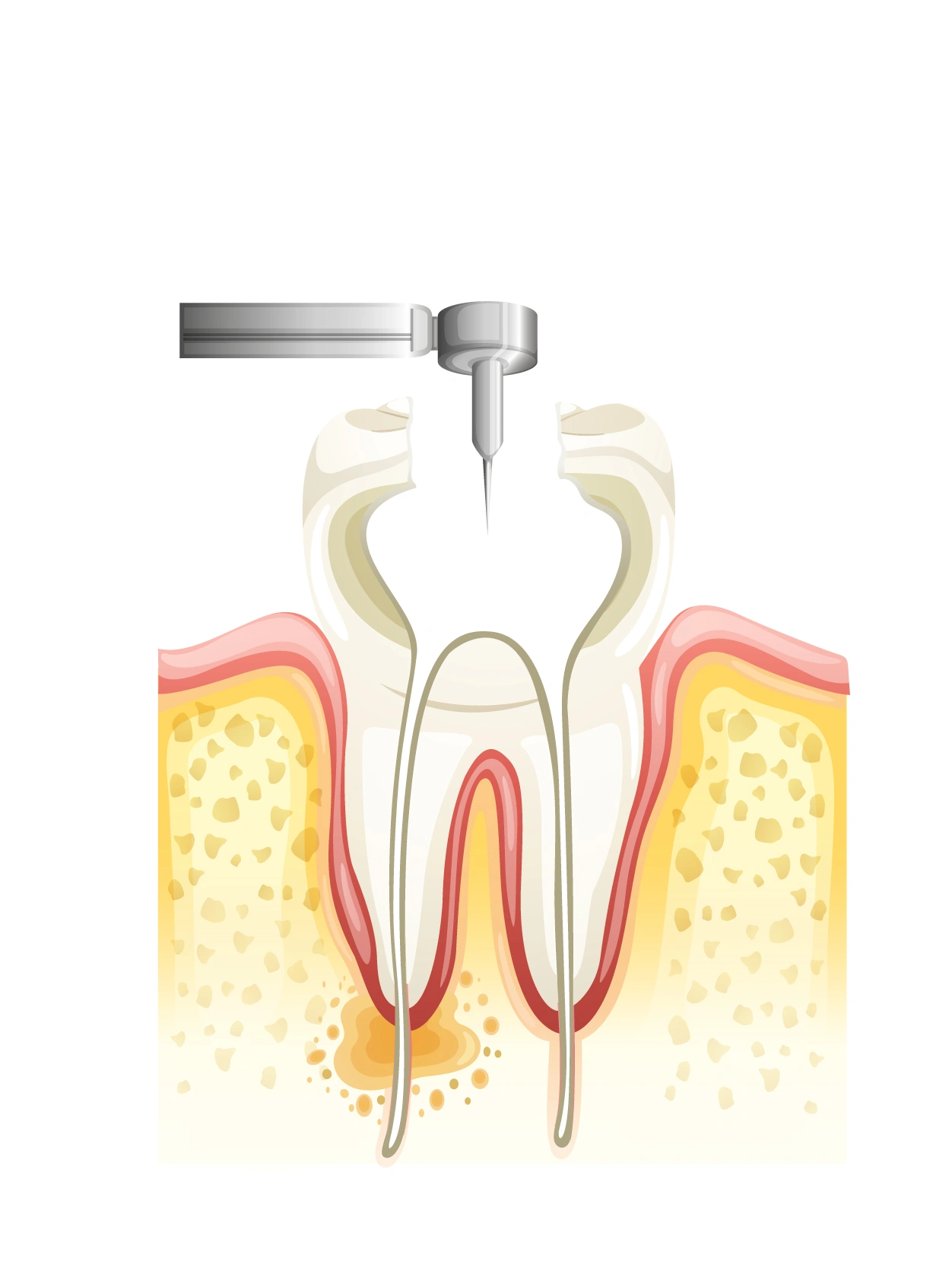 Removing soft tissue