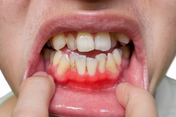 Cracked tooth diagram