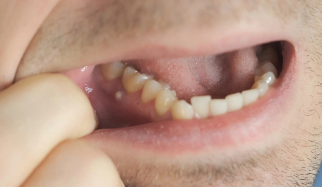 Pus or boil near tooth