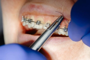 Close-up of discolored teeth