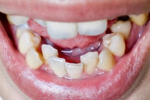 Pus or boil near tooth