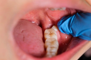 Cracked tooth diagram