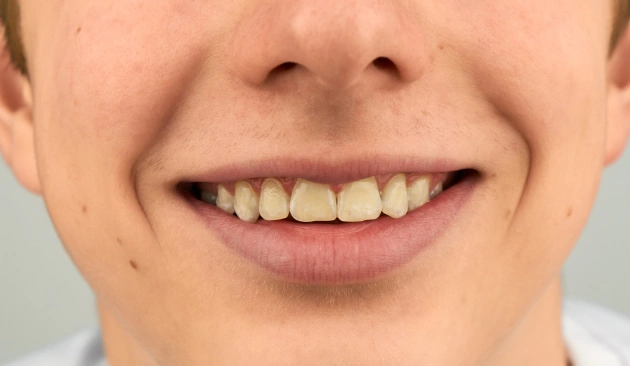 Pus or boil near tooth