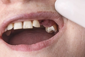 Close-up of discolored teeth