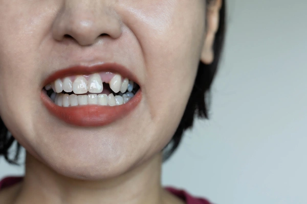 Pus or boil near tooth