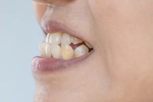 Pus or boil near tooth