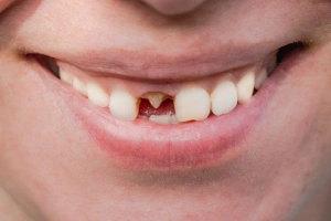 Close-up of discolored teeth
