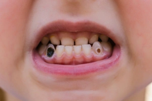 Cracked tooth diagram