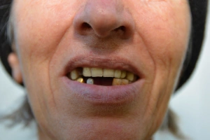 Close-up of discolored teeth