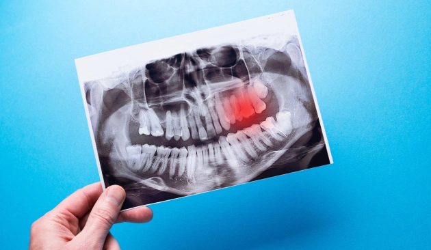 Root Canal Treatment Diagram