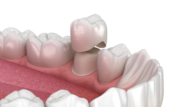 Root Canal Treatment Diagram