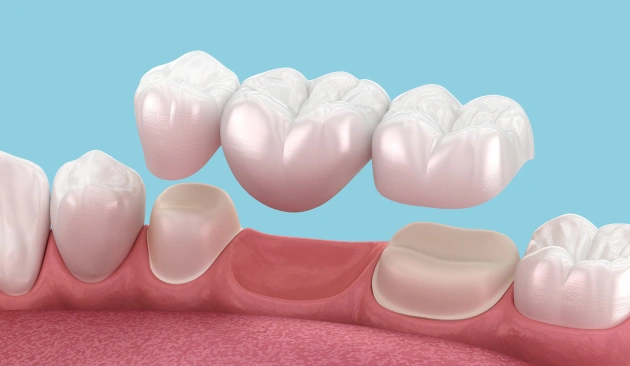Root Canal Treatment Diagram