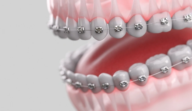 Root Canal Treatment Diagram