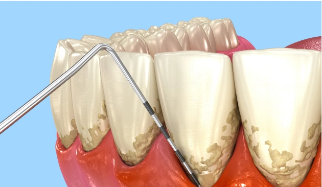 Root Canal Treatment Diagram