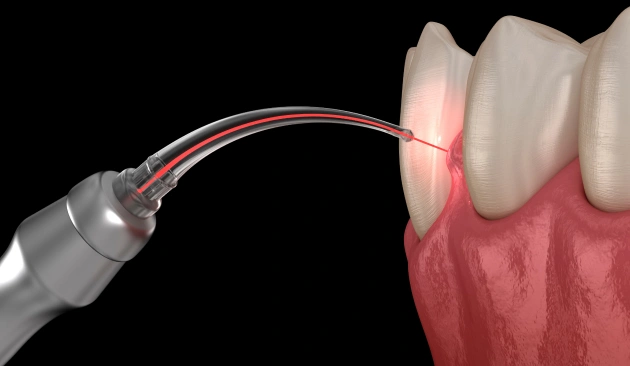 Root Canal Treatment Diagram