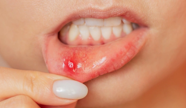 Root Canal Treatment Diagram