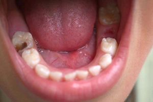 Tooth with large cavity