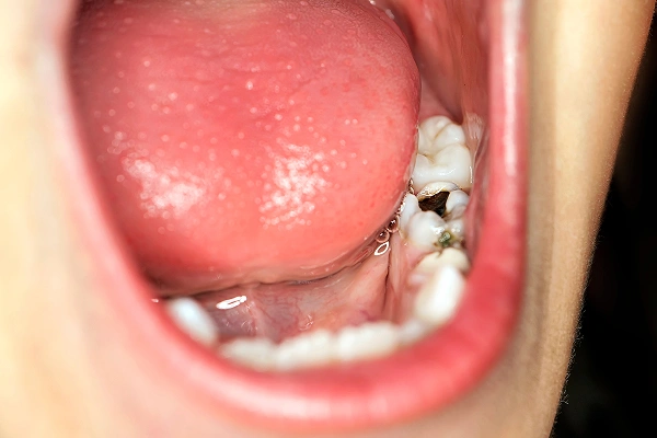 Man holding cheek in pain