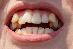 Close-up of discolored teeth
