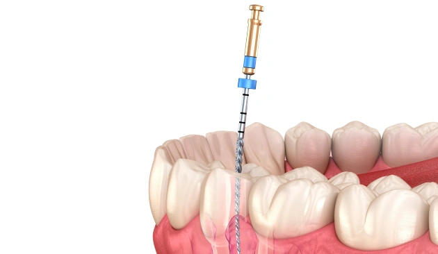 Root Canal Treatment illustration