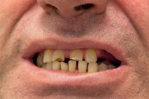 Close-up of discolored teeth