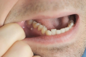 Pus or boil near tooth